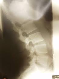 腰椎レントゲン