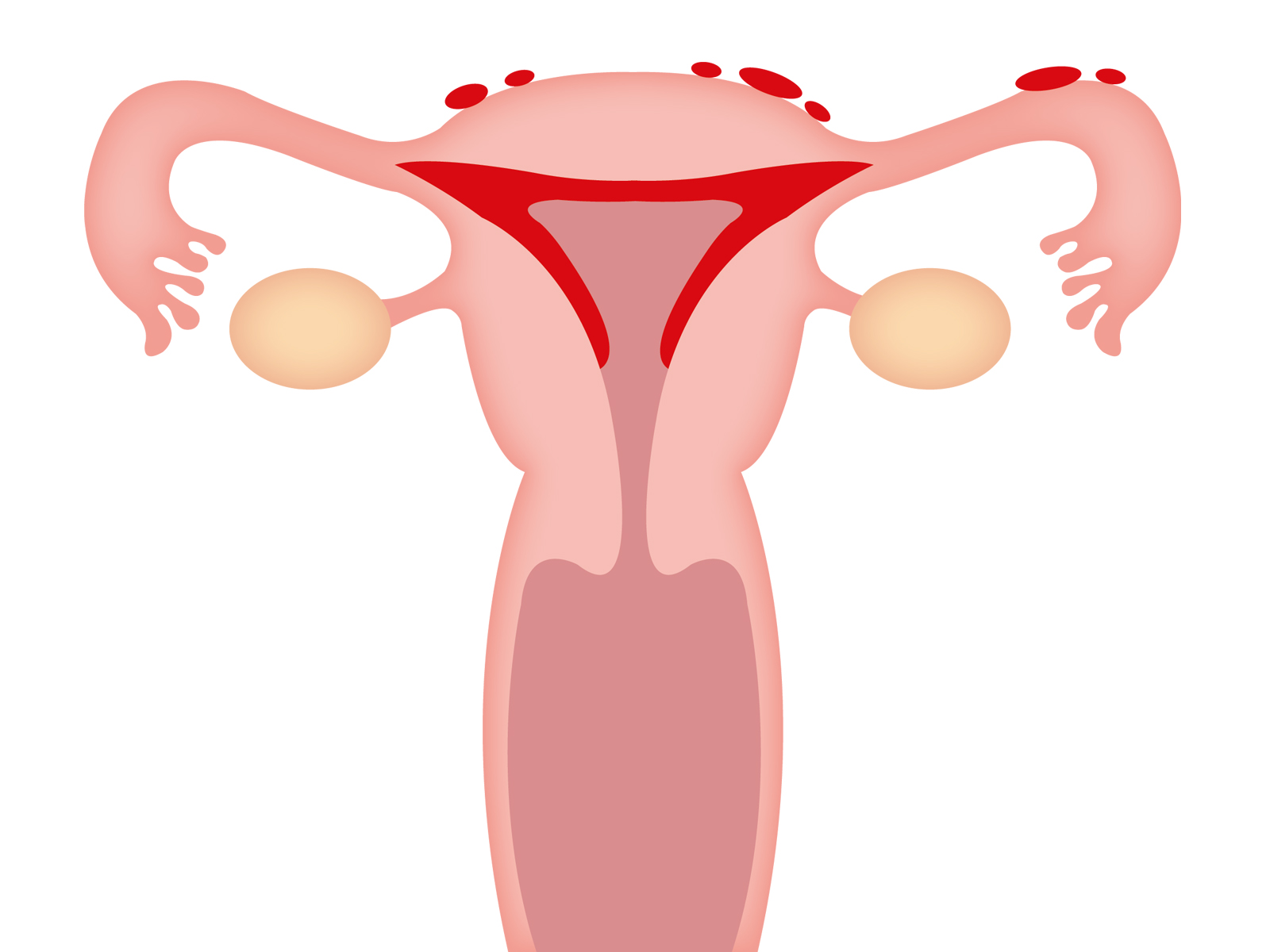 最近20~30代で子宮内膜症が増加傾向にあるらしい件